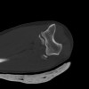 SPORK, NICO - 22.03.1976 - 02.08.2022 - CT obere Extremität - 18:02:23